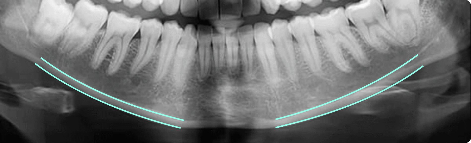 OsteoDent analysis